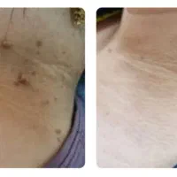 پاکسازی ۲۴ساعته زگیل و خال|آرایشی، بهداشتی، درمانی|تهران, چیتگر شمالی|دیوار