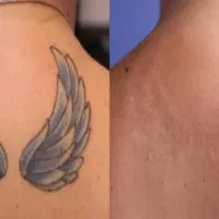 پاک کردن ریمو تتو تضمینی بدون لیزر و فوری