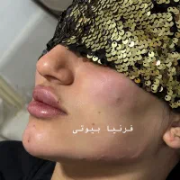 ژل و بوتاکس فرنیا بیوتی