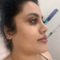 تزریق چربی به تمام نواحی|خدمات آرایشگری و زیبایی|قزوین, |دیوار