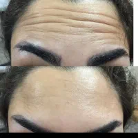 مدل ژل وبوتاکس|خدمات آرایشگری و زیبایی|اهواز, فاز ۲ پادادشهر|دیوار