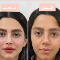 بوتاکس لیبل دار واحدی ۲۰۰ ژل اورجینال توسط پزشک|خدمات آرایشگری و زیبایی|اصفهان, احمدآباد|دیوار