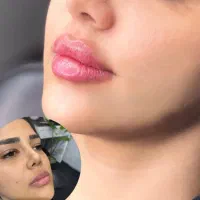 ژل و بوتاکس