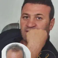 کاشت مو‌ تضمینی