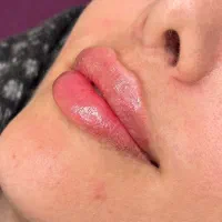 تزریق بوتاکس و فیلر فقط قیمت متریال