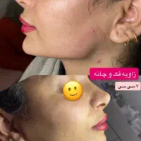 جشنواره فیلر و بوتاکس با بهترین متریال