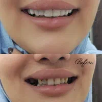 اسنپ اسمایل( لمینیت متحرک)