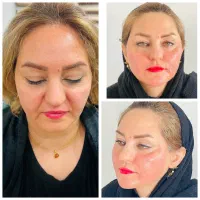 کانتورینگ کامل صورت پرداخت در سه قسط