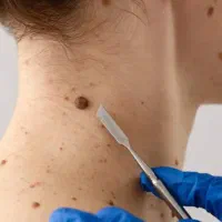 محلول درمان زگیل و زگیل تناسلی