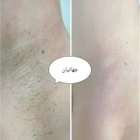 لیزر موهای زائد