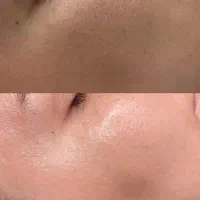 میکرونیدلینگ