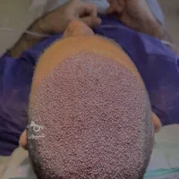 کاشت مو پرتراکم با تضمین کتبی نقد اقساط