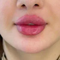 تزریق ژل و فیلر لب،گونه،چانه(جشنواره)درمطب فقط499ت