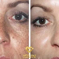 پاک کردن تتو با کیوسوییچ|خدمات آرایشگری و زیبایی|ارومیه, |دیوار