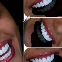 ایمپلنت و کامپوزیت دندان فقط از 10|خدمات آرایشگری و زیبایی|نورآباد, |دیوار