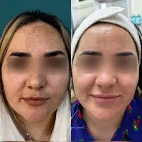 مدل جهت کار درمان تلفیقی پوست|خدمات آرایشگری و زیبایی|چالوس, |دیوار