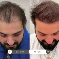 خواهان مدل برای prp مو و صورت|خدمات آرایشگری و زیبایی|سنندج, |دیوار