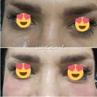ژل بوتاکس پی آرپی لیفت مزوتراپی توسط پزشک در مطب|خدمات آرایشگری و زیبایی|اسلام‌شهر, باغ فیض|دیوار