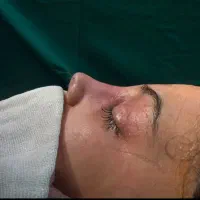 مرکز جراحی زیبایی بینی رینوپلاستی سیما در سرچشمه