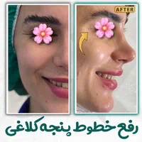 فیلر(ژل) لب گونه چانه خط خنده زاویه توسط پزشک رشت|خدمات آرایشگری و زیبایی|رشت, گلسار|دیوار