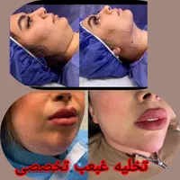 ساکشن غبغب وشکم. کاشت ابرو .|خدمات آرایشگری و زیبایی|پرند, |دیوار