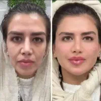 تزریق چربی ،تخلیه چربی