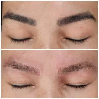 کربن تراپی/لیزر تتو/لیزر مو زائد/ژل و بوتاکس/فیشال