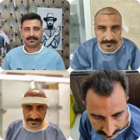کاشت مو fueپلاس|خدمات آرایشگری و زیبایی|شیراز, قصرالدشت|دیوار