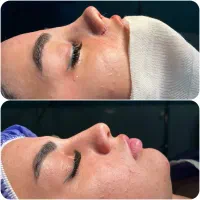 جراحی زیبایی بینی و ترمیمی|خدمات آرایشگری و زیبایی|قائمشهر, |دیوار