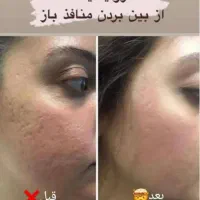 انجام خدمات مزوتراپی و مزوندیلینگ