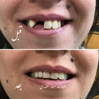 دندانسازی سکندری کرمان دندان ایتالیایی لثه نرم|خدمات آرایشگری و زیبایی|کرمان, |دیوار