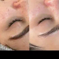 فیشیال (خانم و اقا)بوتاکس ..