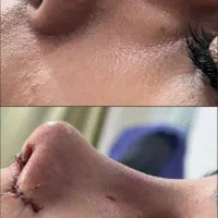 اف عمل زیبایی بینی ۲۵ میلیون