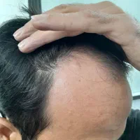 جراحی خال زگیل و میخچه و ناخن با لیزر در مطب پزشک|خدمات آرایشگری و زیبایی|قم, میرزائیه|دیوار