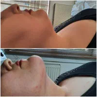 تزریق فیلر بوتاکس ساکشن چربی وتزریق چربی