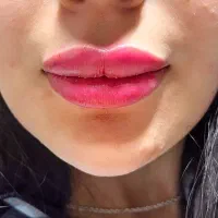 تخفیفات ویژه پاییزه بوتاکس فیلر ژل لب مزوتراپی