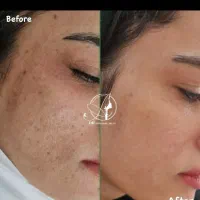 مزوندلینگ ،میکرونیلدینگ و درمان تخصصی لک|خدمات آرایشگری و زیبایی|بیرجند, |دیوار