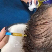 پی آر پی فقط ۸۵۰ بالاترین جوابدهی فیلربادی جوانساز