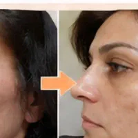 کرم بیوممتیک ضد لک و تیرگی پوست