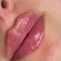 ژل بوتاکس ۴۹۹