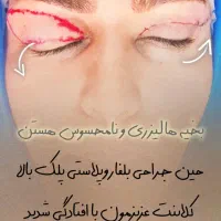 بلفاروپلاستی ، لیپو غبغب، تزریقات جوانساز|خدمات آرایشگری و زیبایی|تهران, دهم فروردین|دیوار