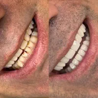 کامپوزیت فکی 10|خدمات زیبایی و سلامت|تهران, یاخجی آباد|دیوار