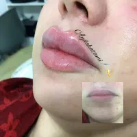 تزریق ژل و بوتاکس توسط پیرا پزشک مجرب|خدمات آرایشگری و زیبایی|اهواز, پادادشهر|دیوار