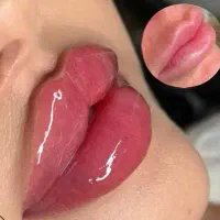 تخفیفات پاییزه   ژل ، بوتاکس ، فیلر،جوانسازی پوست|خدمات آرایشگری و زیبایی|تهران, نیروی هوایی (پیروزی)|دیوار