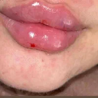 تزریق ژل (فیلر) و بوتاکس|خدمات آرایشگری و زیبایی|شیراز, عادل آباد|دیوار