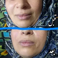 اف ۵۰٪ژل و بوتاکس و مزو...|خدمات آرایشگری و زیبایی|اهواز, اهواز|دیوار