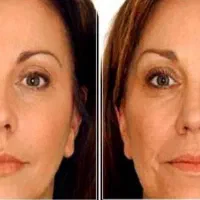 مزوژل، آبرسانی،شادابی وجوانی پوست