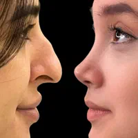 50%تخفیف ویژه عمل جراحی بینی بدون تامپون لیفت|خدمات آرایشگری و زیبایی|فردیس, طالقانی|دیوار