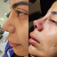 آف عمل بینی ۲۳ت دراهوازوماموپلاستی سینه
