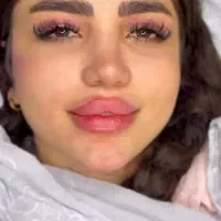 تخفیف 50 درصدی تزریق ژل و بوتاکس|خدمات آرایشگری و زیبایی|ارومیه, |دیوار